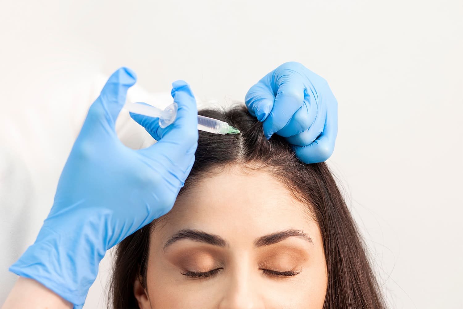 Quanto Custa o Tratamento com Exossomos para Calvície?