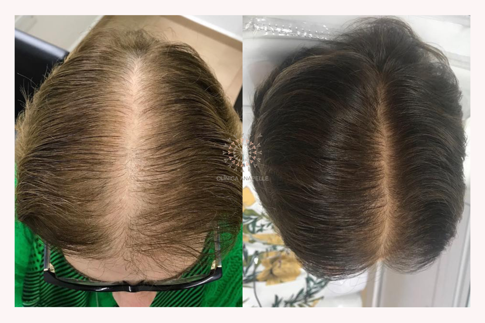 Benefícios dos exossomos no couro cabeludo