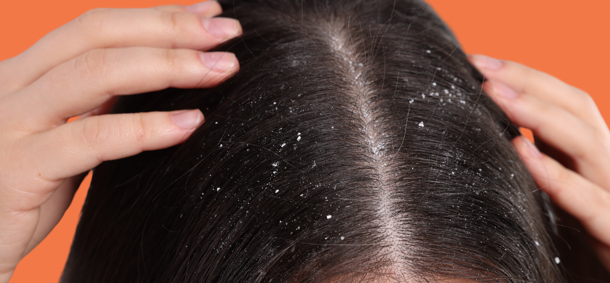 Cabelo Caindo Muito
