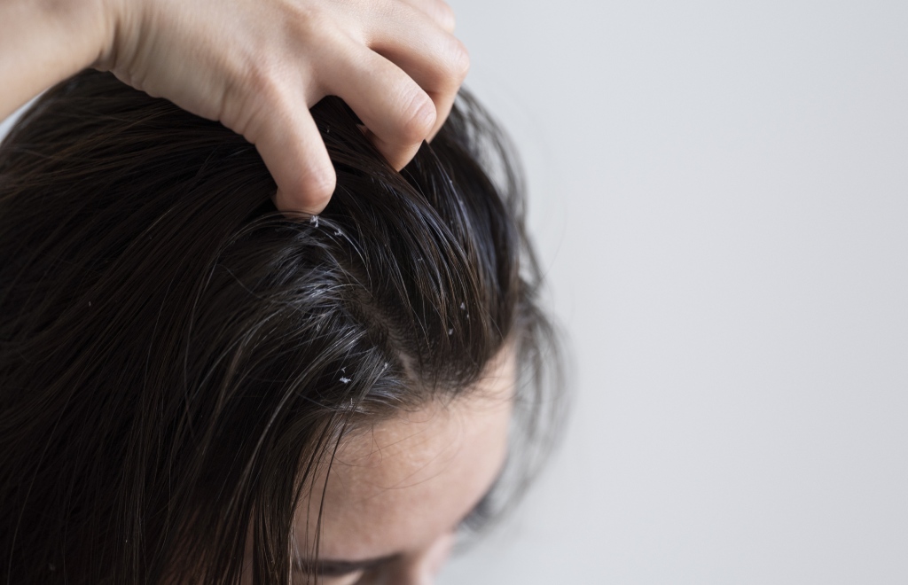 Fatores hormonais e cabelo oleoso: o que você precisa saber