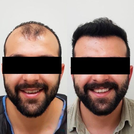 Como identificar a necessidade de uma revisão de transplante capilar