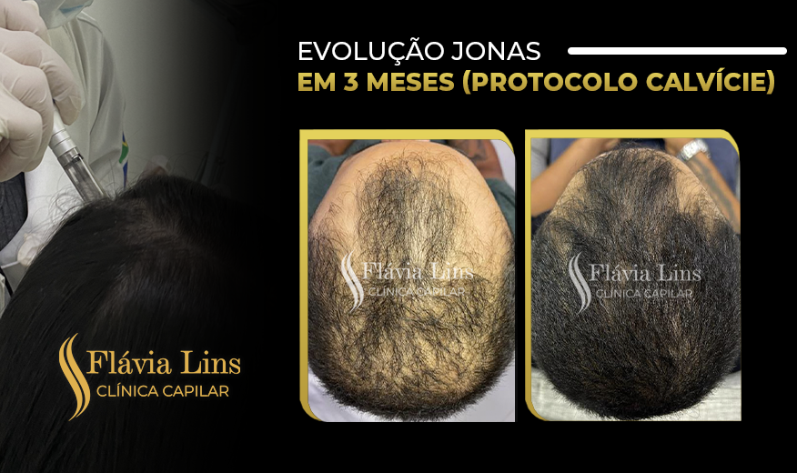 Clínica capilar em Caruaru PE