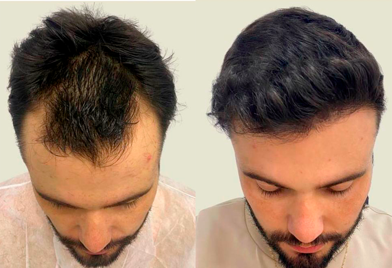 Clínica com robô de transplante capilar SP