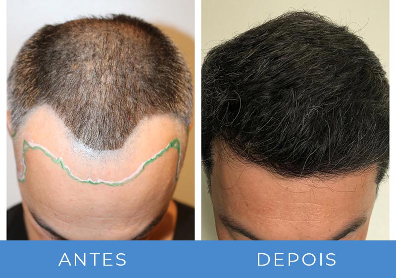 5 ideias de títulos:
1. Transplante Capilar Robótico vs. Manual: Qual a Melhor Escolha para Você?
2. Clínica Everin: Inovação e Exclusividade no Transplante Capilar Robótico em SP
3. Entenda o Processo e os Benefícios do Transplante Capilar com o Robô ARTAS
4. Guia Completo de Preços e Fatores que Influenciam o Custo do Transplante Capilar Robótico
5. Recuperação Pós-Transplante Capilar: Dicas Essenciais para Técnicas Robóticas e Manuais