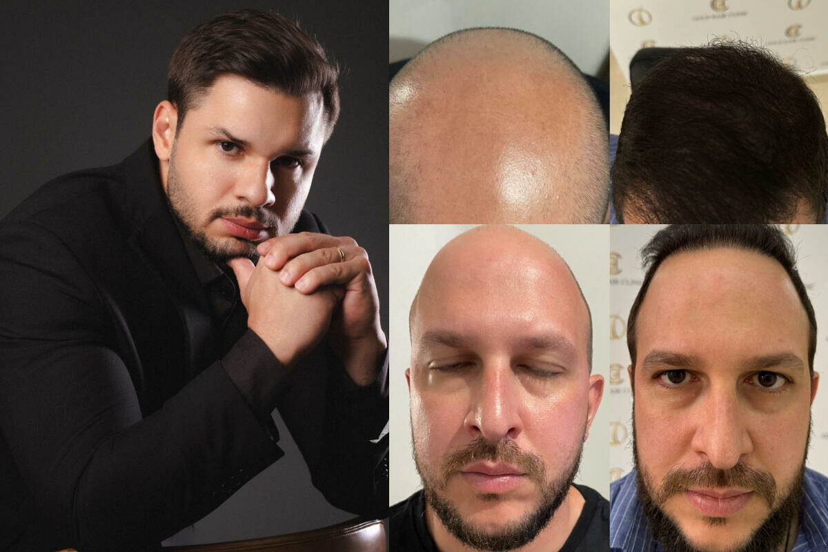 Clínica com robô de transplante capilar SP