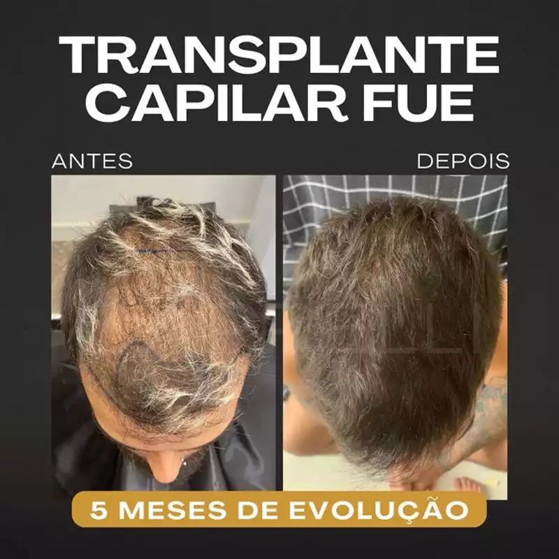 Clínica com robô de transplante capilar SP