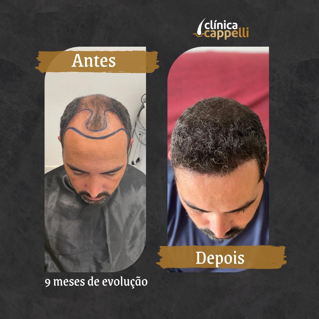 5 ideias de títulos:
1. Transplante Capilar Robótico vs. Manual: Qual a Melhor Escolha para Você?
2. Clínica Everin: Inovação e Exclusividade no Transplante Capilar Robótico em SP
3. Entenda o Processo e os Benefícios do Transplante Capilar com o Robô ARTAS
4. Guia Completo de Preços e Fatores que Influenciam o Custo do Transplante Capilar Robótico
5. Recuperação Pós-Transplante Capilar: Dicas Essenciais para Técnicas Robóticas e Manuais