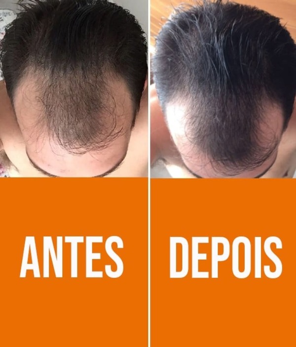 melhores tratamentos doenças capilares raras