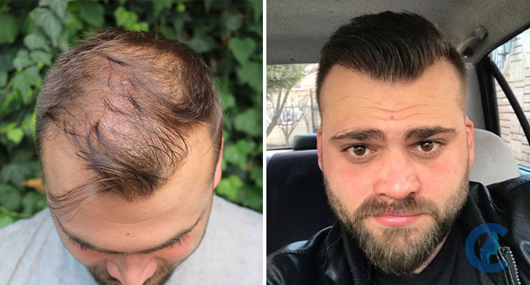 erros comuns transplante capilar caxias do sul evitar