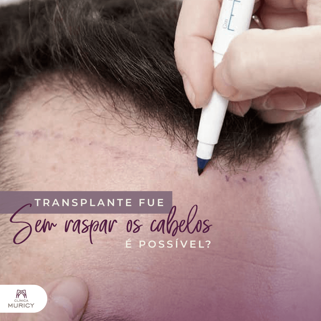 transplante capilar sem raspar sp