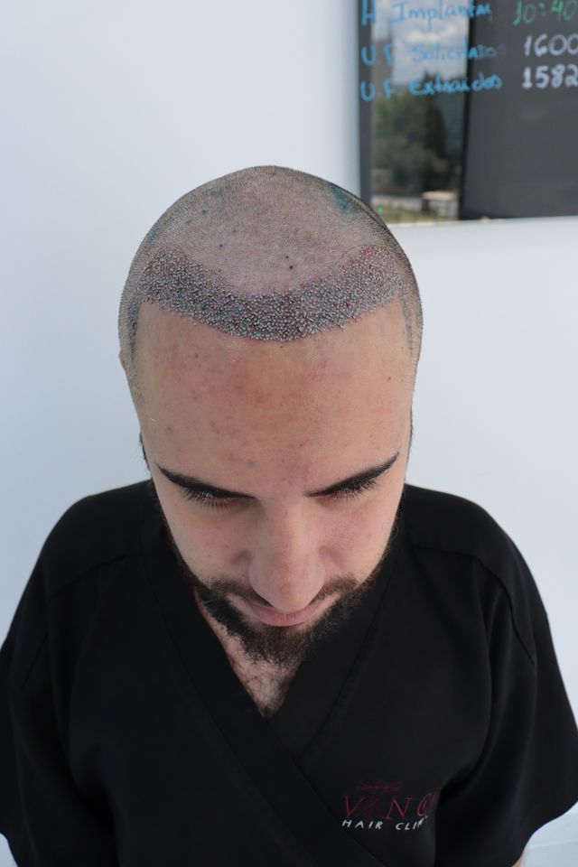 Transplante Capilar FUE vs FUT: Qual a Melhor Técnica para Você em 2026?