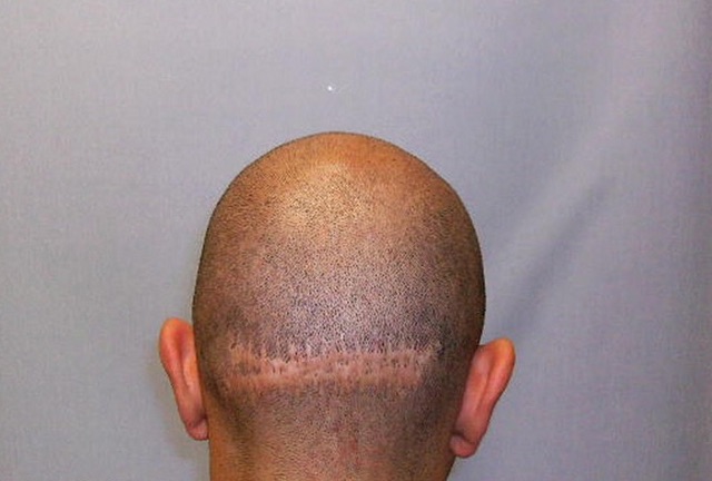 Plano de Saúde Cobre Implante Capilar? Entenda as Exceções e Coberturas