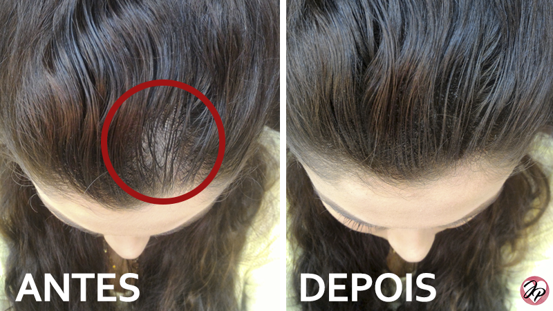 Quando Procurar um Dermatologista para Queda de Cabelo e Falhas