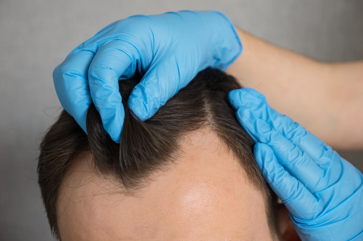 Alopecia por Tração: Causas