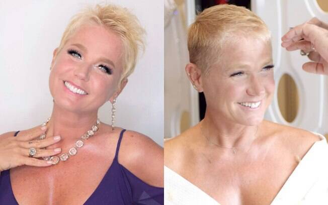 Por Que Xuxa Raspou o Cabelo? Entenda a Alopecia Androgenética