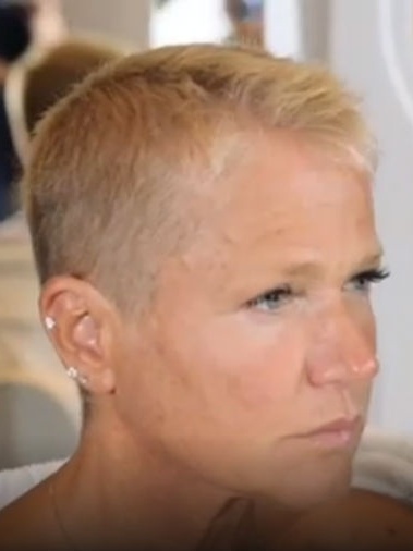 Por Que Xuxa Raspou o Cabelo? Entenda a Alopecia Androgenética