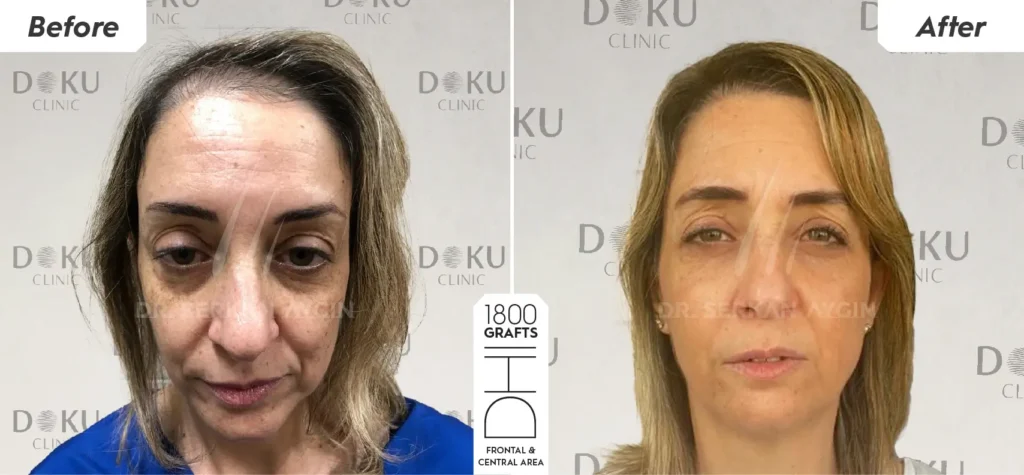 Custo de vida e transplante capilar exterior