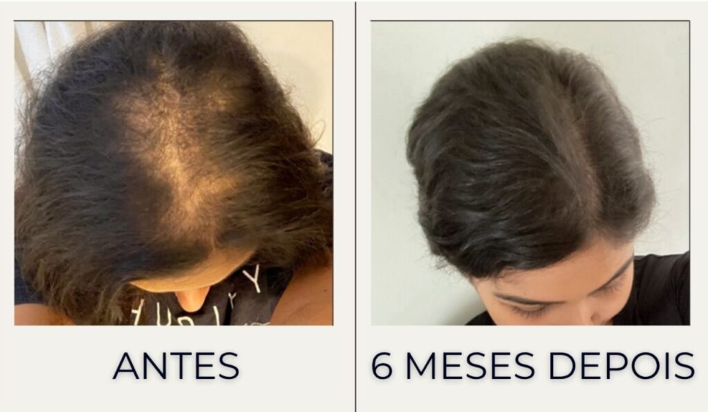 Custo transplante capilar feminino Boa Vista