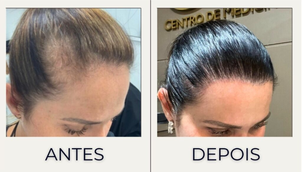 melhores clínicas transplante capilar feminino Boa Vista