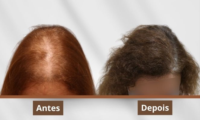 erros comuns ao escolher clínica transplante capilar feminino