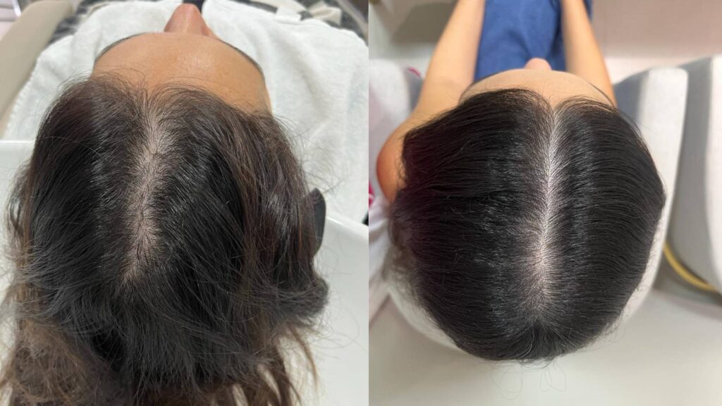 melhores resultados dermapen couro cabeludo