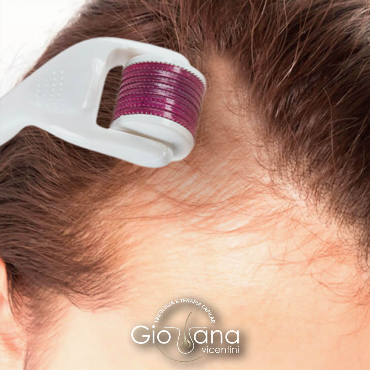 perigos microagulhamento capilar caseiro