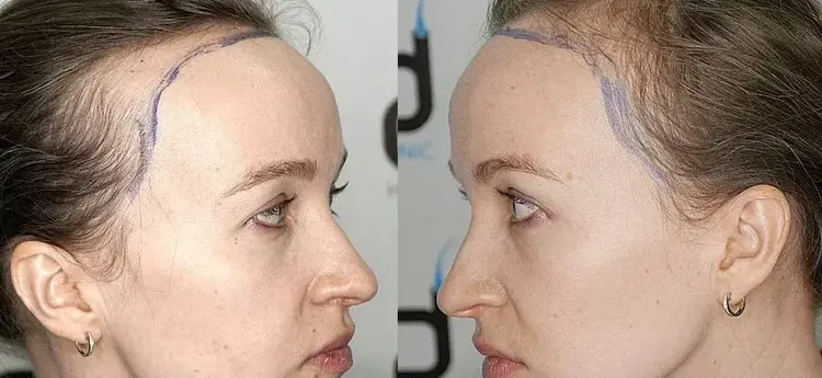 O Papel do Dermatologista na Avaliação Pré-Transplante Capilar Feminino