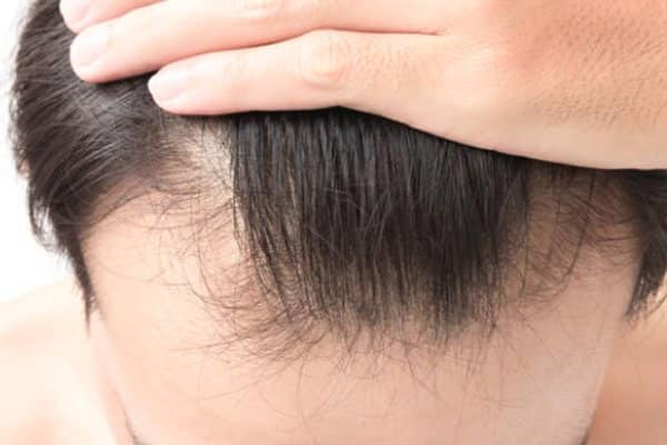 Especialista em alopecia de tração SP