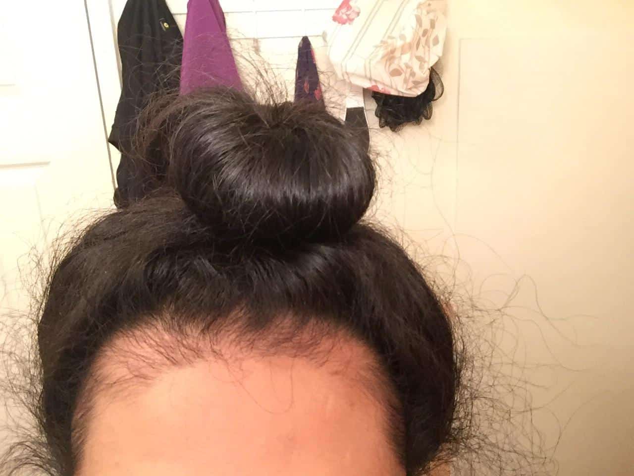 Especialista em alopecia de tração SP