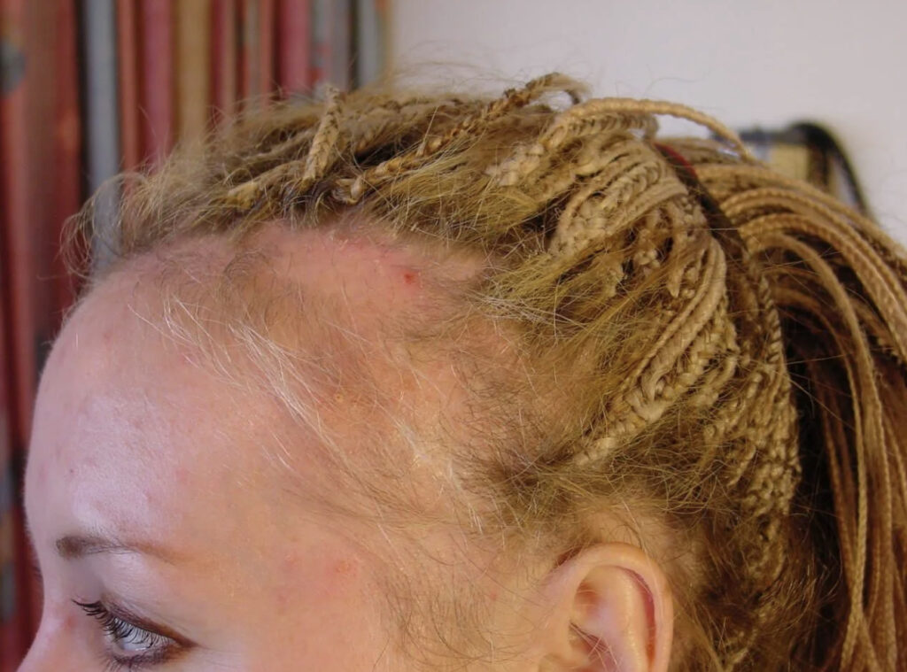 Especialista em alopecia de tração SP