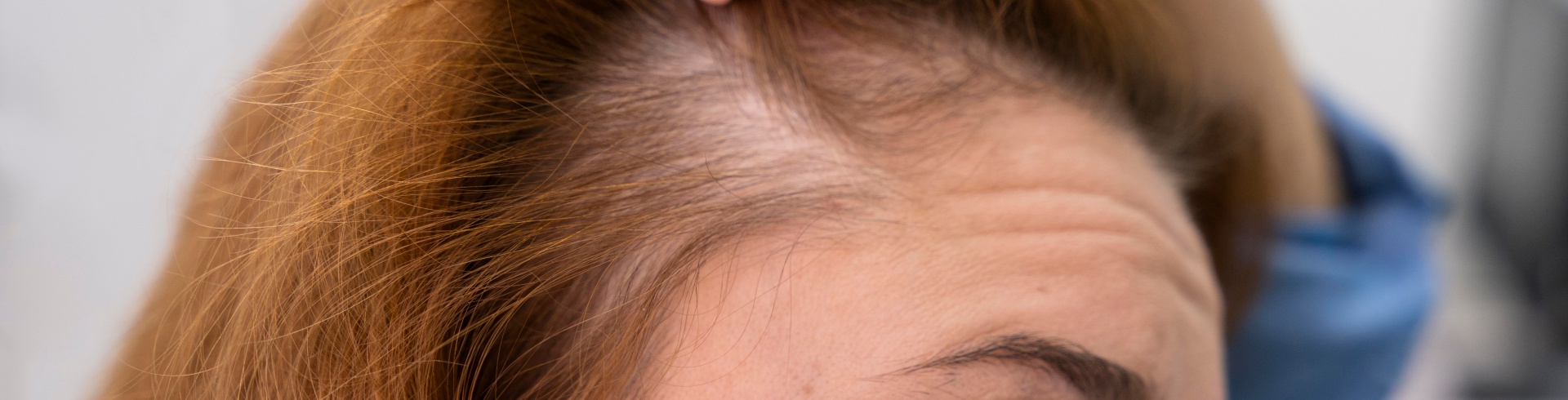 Como identificar e prevenir a alopecia de tração: Guia completo; Os melhores tratamentos para alopecia de tração: Opções e resultados; Tricologia em São Paulo: Encontre o especialista ideal para sua saúde capilar; Penteados que causam alopecia de tração: Evite danos aos seus fios; Diferença entre alopecia de tração reversível e irreversível: O que você precisa saber; Mitos e verdades sobre a queda de cabelo por tração