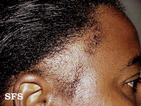 Especialista em alopecia de tração SP