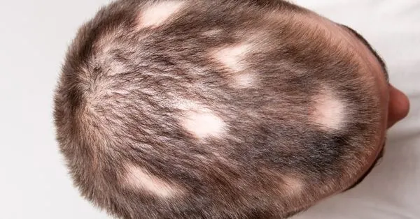 Como identificar e prevenir a alopecia de tração: Guia completo; Os melhores tratamentos para alopecia de tração: Opções e resultados; Tricologia em São Paulo: Encontre o especialista ideal para sua saúde capilar; Penteados que causam alopecia de tração: Evite danos aos seus fios; Diferença entre alopecia de tração reversível e irreversível: O que você precisa saber; Mitos e verdades sobre a queda de cabelo por tração