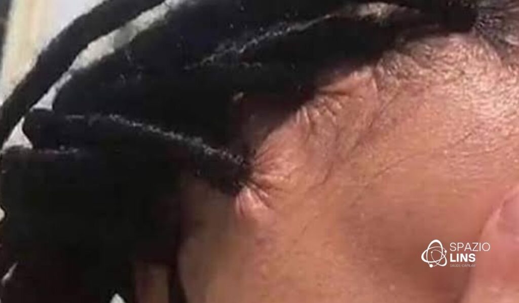 Especialista em alopecia de tração SP