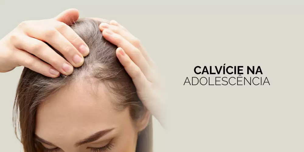 Especialista em alopecia em Maringá