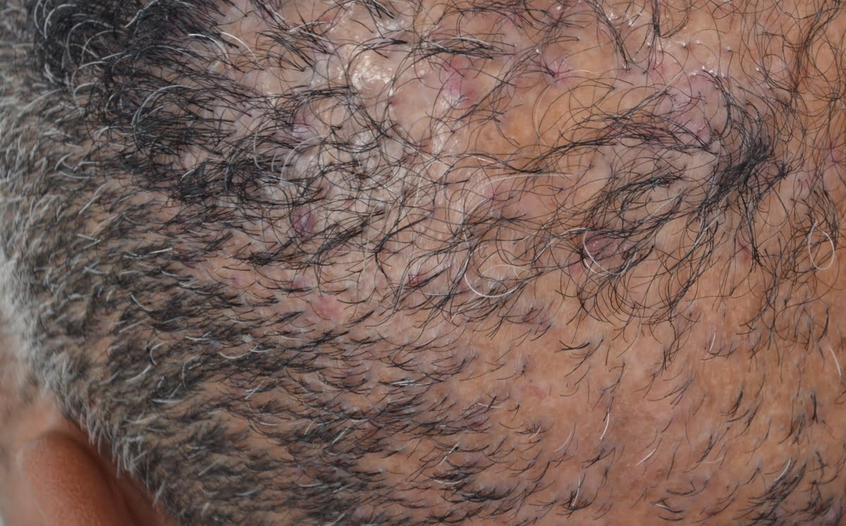 Especialista em foliculite decalvante SP