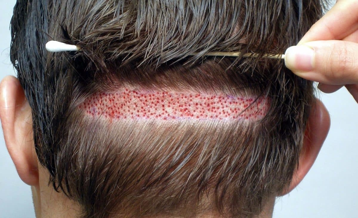 Diferenças entre DHI e FUE para Transplante Capilar Feminino