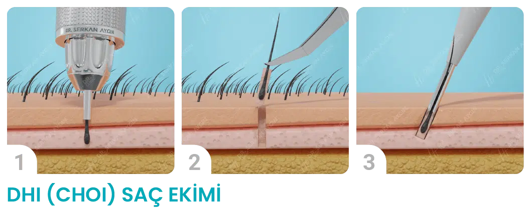 Transplante Capilar Feminino: O Guia Completo do Pós-Operatório