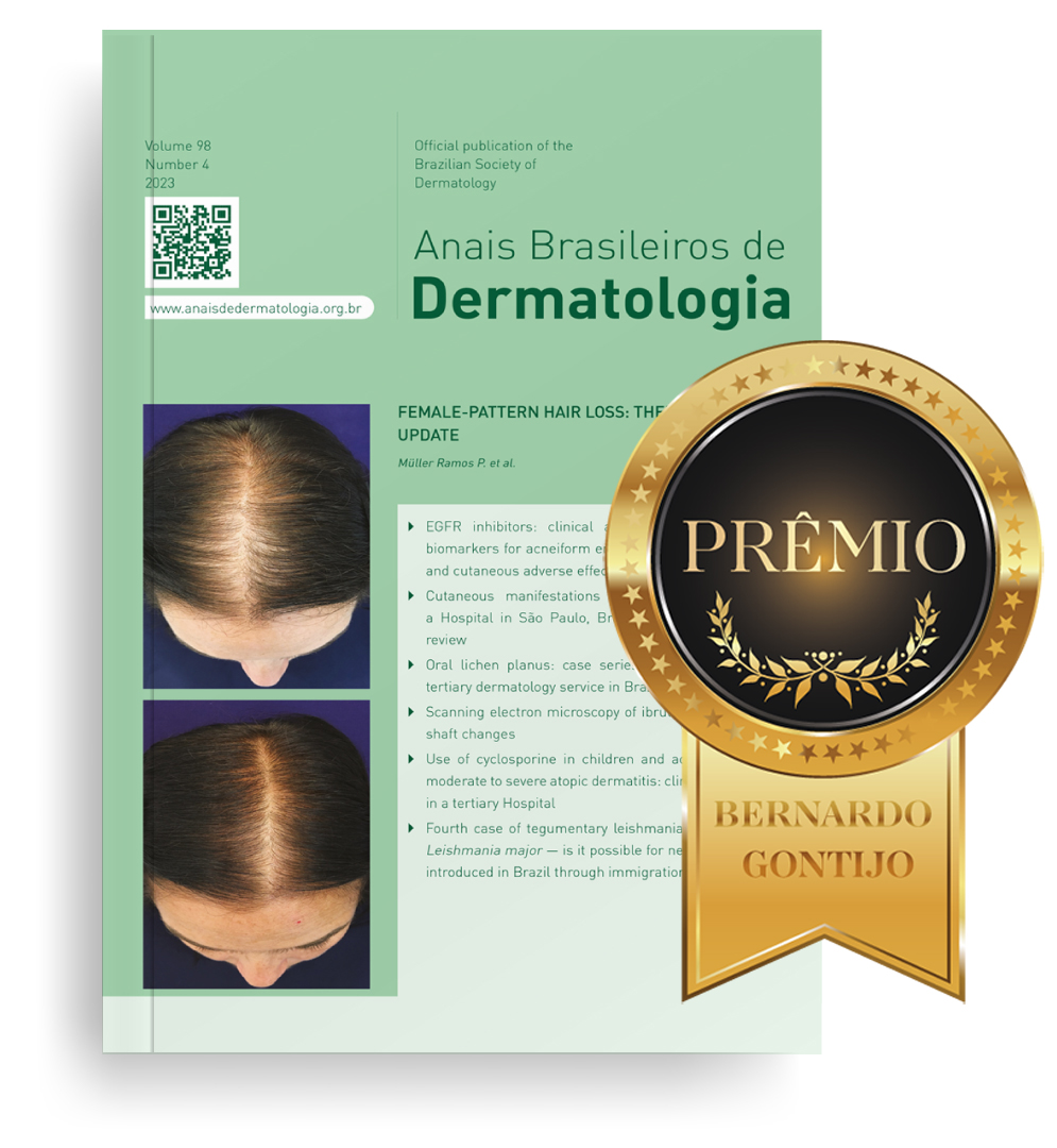 Alopecia Areata Grave: Opções de Tratamento e Acesso no Brasil