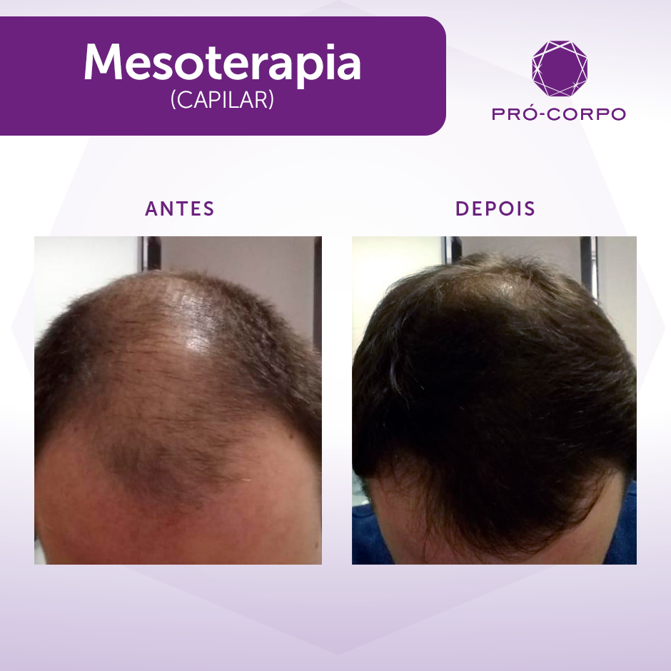 melhores resultados mesoterapia capilar antes e depois