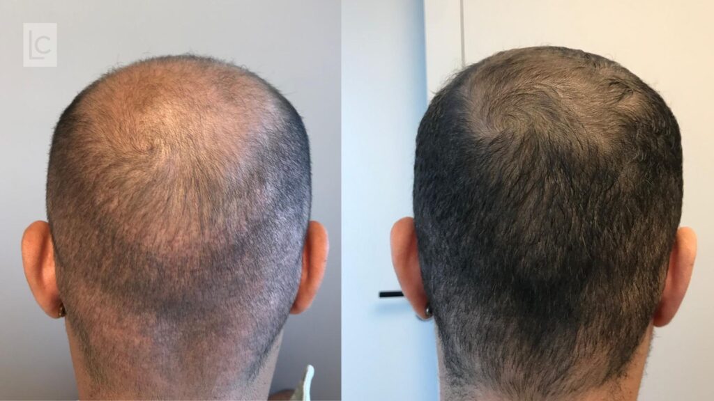 mesoterapia capilar não funciona o que fazer