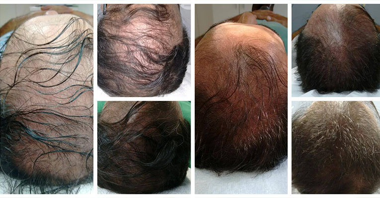 MMP Capilar: Tudo o que Você Precisa Saber Antes de Fazer