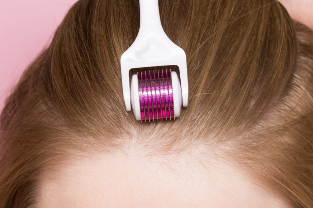 Quantas Sessões de Microagulhamento Capilar São Necessárias?