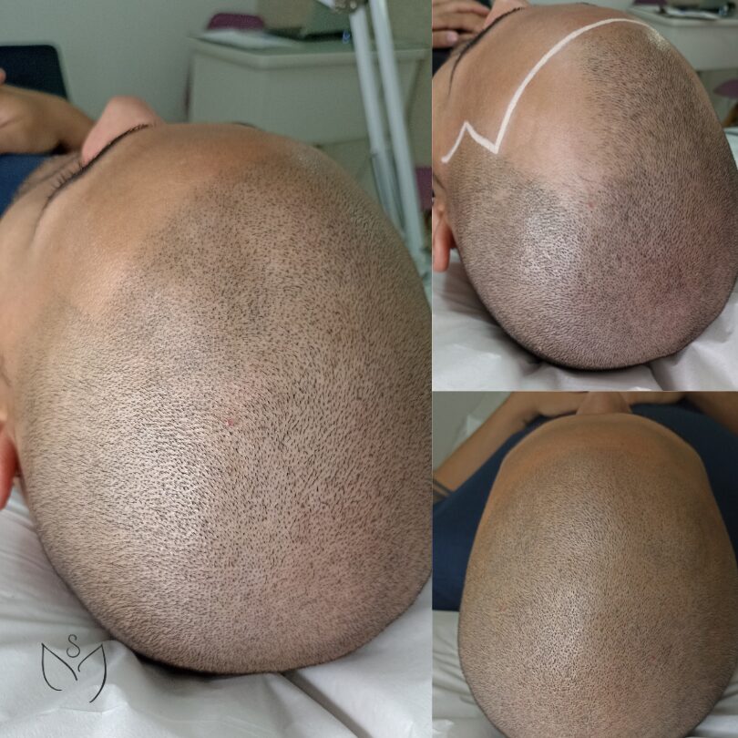 Fatores que Influenciam a Durabilidade da Micropigmentação Capilar: Dicas e Mitos