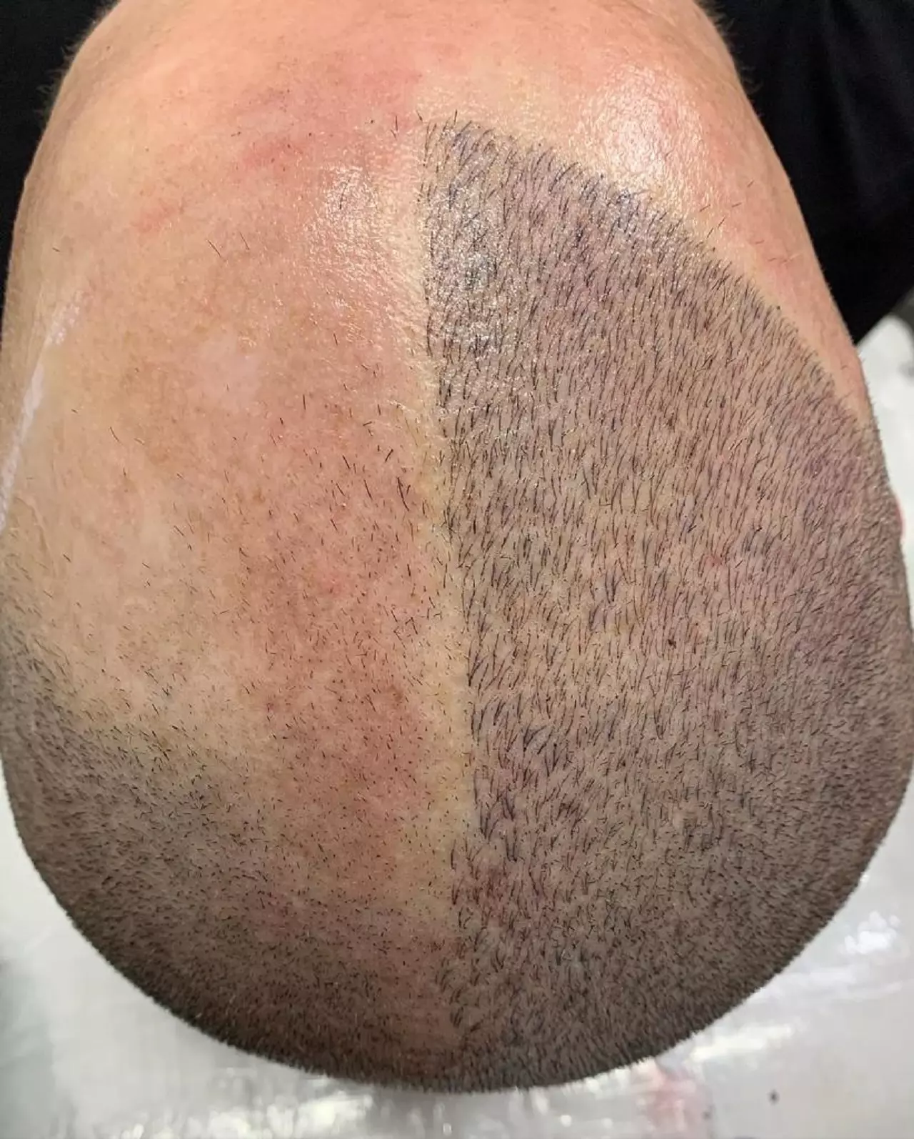 Micropigmentação Capilar: Efeito Raspado vs. Efeito Densidade – Qual o Melhor para Você?