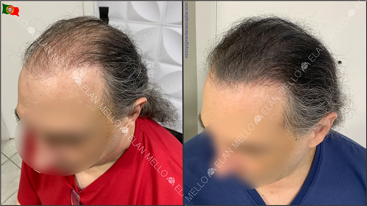 Micropigmentação Capilar: Efeito Raspado vs. Efeito Densidade – Qual o Melhor para Você?