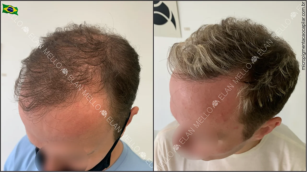 Como Escolher a Melhor Clínica de Micropigmentação Capilar em São Paulo?