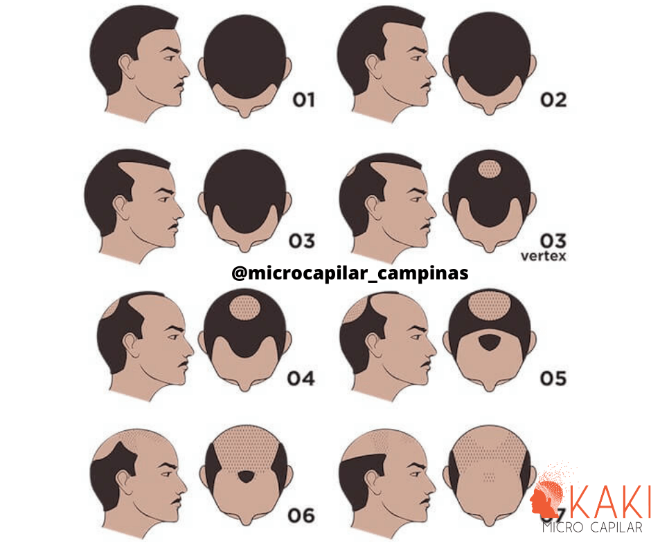 Como Escolher a Melhor Clínica de Micropigmentação Capilar em São Paulo?