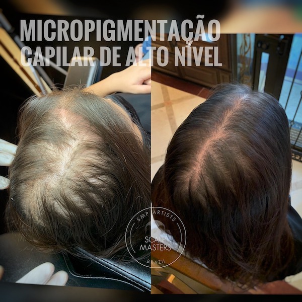 Micropigmentação Capilar Feminina: Solução para Rarefação e Volume