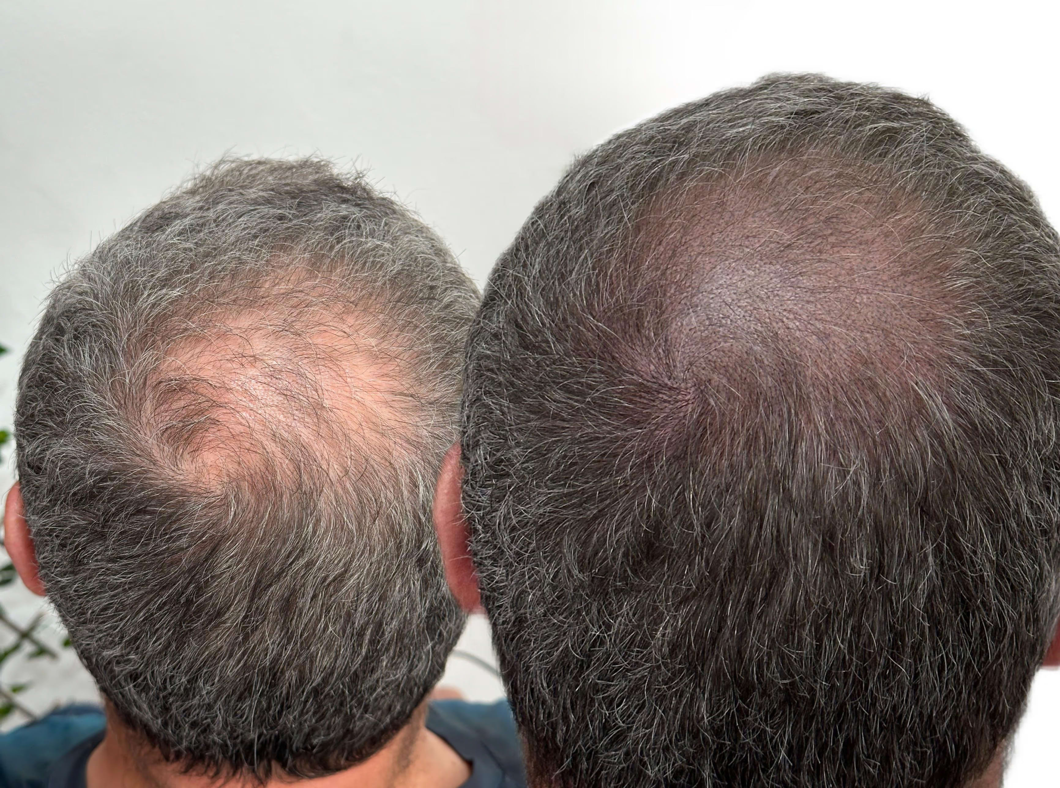 Micropigmentação capilar efeito densidade valor